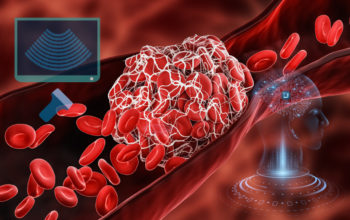 machine learning to diagnose deep vein thrombosis
