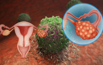 new approach for ovarian immunotherapy resistant cancer